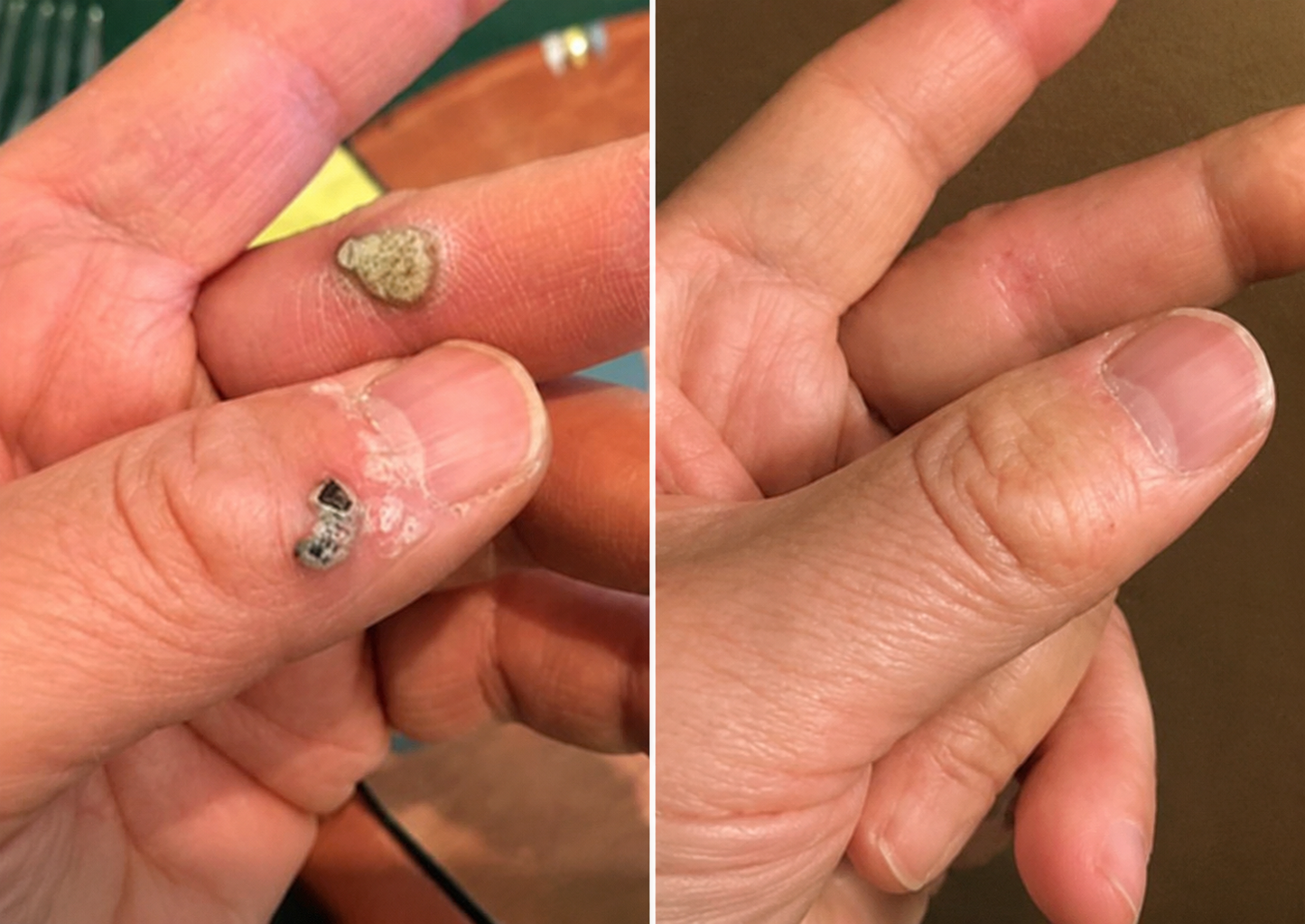 🔥 LAST DAY SALE-80% OFF✨Curalona®2-in-1 Microneedle & Hydrocolloid Patch🍀| Removes Raised Moles, Acne, Flat Warts & Skin Tags | Helps Improve Wrinkles, Scars & Blemishes | Invisible Patches for Face & Body